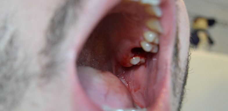 blood clot wisdom teeth bad