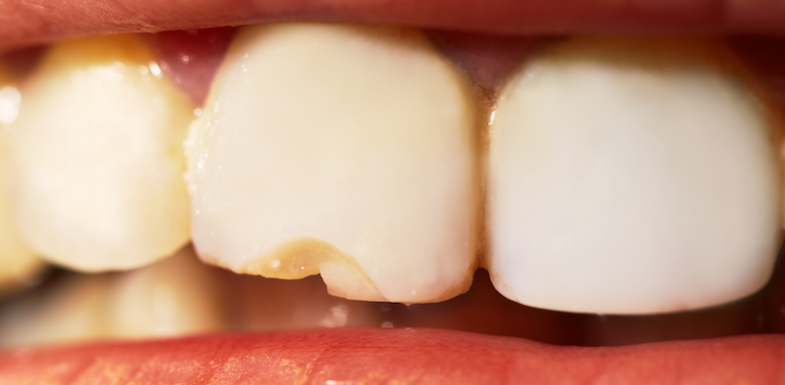Cracked Tooth Repair and 5 Reasons to Visit a Cosmetic Dentist