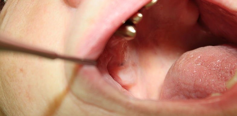 Mouth Pigmentation Part 1 | Intelligent Dental