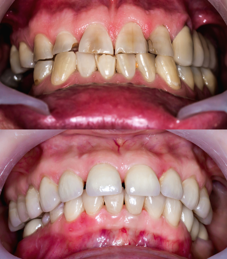 Full Mouth Reconstruction Before And After Photos | AZDentist.com