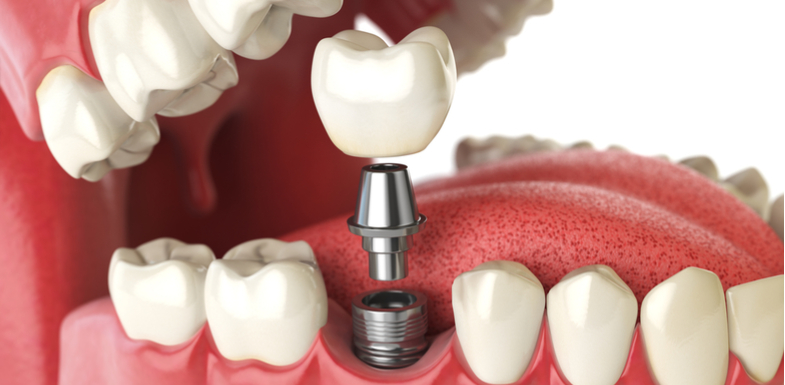 Types Of Dental Implants: Which One Is Right For Me? | AZ Dentist