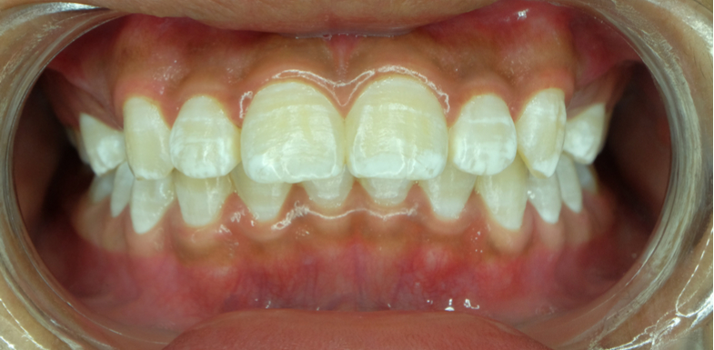 How To Get Rid of White Spots On Teeth: 8 Treatments - AZ Dentist
