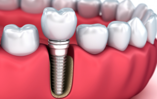 How Do Dental Implants Work And What Can I Expect During The Procedure? | AZ Dentist