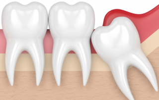 What To Expect With Wisdom Tooth Extraction Recovery: 5 FAQs | AZ Dentist
