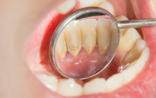 How To Remove Tartar Buildup On Teeth: 7 Tips | AZ Dentist