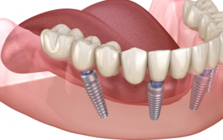 How Can All-On-4 Dental Implants Help Me? | AZ Dentist